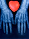 X-ray plate of the bones of the both human hands and red heart sign Royalty Free Stock Photo