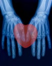X-ray plate of the bones of the both human hands and red heart sign Royalty Free Stock Photo