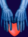 X-ray plate of the bones of the both human hands and red heart sign Royalty Free Stock Photo