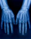 X-ray plate of the bones of the both human hands Royalty Free Stock Photo