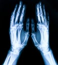 X-ray plate of the bones of the both human hands Royalty Free Stock Photo