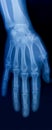X-ray plate of the bones of the human hand Royalty Free Stock Photo