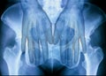 X-ray plate of the both human hands and pelvic bones. Royalty Free Stock Photo