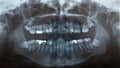 X-Ray of problematic wisdom teeth Royalty Free Stock Photo