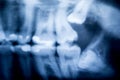 X-Ray of problematic wisdom teeth Royalty Free Stock Photo