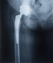 X-ray of a prosthesis of a female hip joint. Joint endoprosthetics Royalty Free Stock Photo