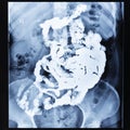 Barium study of small bowel after sixty minutes