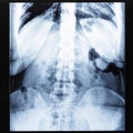 X-ray radiogram of human body before Barium study