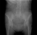 X-ray Radiograph of the pelvis with osteochondropathy of the head of the left femur Royalty Free Stock Photo