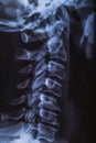 X-ray radiography or roentgen of human neck, medical radiology concept Royalty Free Stock Photo