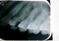 X ray reveals dental inflammation, abscess, a collection of pus that can form inside the teeth, in the gums, or in the bone that