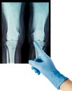 X-ray rheumatic diseases and knee Rheumatoid Arthritis hand in glove Royalty Free Stock Photo