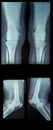 X-ray rheumatic diseases and knee Rheumatoid Arthritis Royalty Free Stock Photo