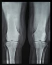 X-ray rheumatic diseases and knee Rheumatoid Arthritis Royalty Free Stock Photo