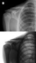 X-ray of the right collarbone. Fracture of clavicle of the child. Positive. Negative.