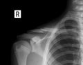 X-ray of the right collarbone. Fracture of clavicle.