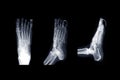 X-ray Right foot image AP , oblique and lateral