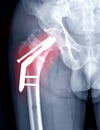 x-ray Right hip showing hip replacement .