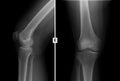 X-ray of the right knee joint. Fracture of the lateral condyle of the tibial.