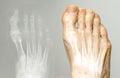 X-ray and the same foot. Royalty Free Stock Photo