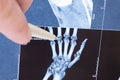 X-ray scan of hand, bones and finger joints. Doctor pointed on finger small joints, where pathology is detected, such as arthritis