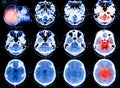 X-Ray scan human for brain