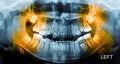 X-Ray scan human for teeth Royalty Free Stock Photo