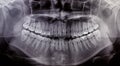 X-Ray scan human for teeth Royalty Free Stock Photo