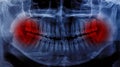 X-Ray scan human for teeth Royalty Free Stock Photo