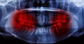 X-Ray scan human for teeth Royalty Free Stock Photo