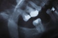 X-ray scan of humans teeth