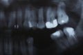 X-ray scan of humans teeth