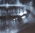 X-ray scan of humans teeth