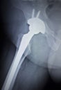 X-ray scan image of hip joint replacement orthopedic implant Royalty Free Stock Photo