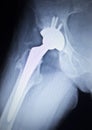 X-ray scan image of hip joint replacement orthopedic implant Royalty Free Stock Photo