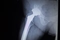 X-ray scan image of hip joint replacement orthopedic implant Royalty Free Stock Photo