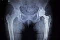 X-ray scan image of hip joint replacement orthopedic implant Royalty Free Stock Photo