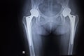 X-ray scan image of hip joint replacement orthopedic implant Royalty Free Stock Photo