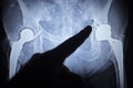 X-ray scan image of hip joint replacement orthopedic implant Royalty Free Stock Photo