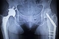 X-ray scan image of hip joint replacement orthopedic implant