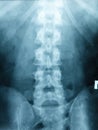X-ray Scoliosis film x-ray lumbar spine AP Royalty Free Stock Photo
