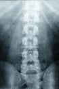 X-ray Scoliosis film x-ray lumbar spine AP Royalty Free Stock Photo