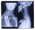 X-ray, Scoliosis