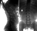 X-ray scoliosis of the lumbar spine. Negative.