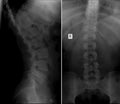 X-ray scoliosis of the lumbar spine. Royalty Free Stock Photo