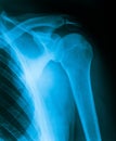 X-Ray of the Shoulder