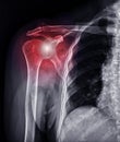 X-ray Shoulder joint for diagnosis shoulder joint dislocation
