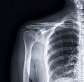 X-ray Shoulder joint shoulder front view for diagnosis fracture of shoulder joint