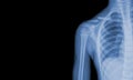 x-ray of the shoulder joint to see injuries clavicle fracture and tendons for a medical diagnosis.Medical image concept and