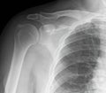 X-ray shoulder joints. Acromioclavicular bones. Medical concept. X-ray shoulder joints structure.